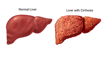 Cirrhosis Treatment in Sheshadripuram